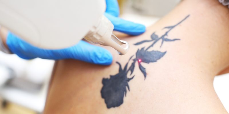 the cosmetologist removes the tattoo to the patient using a neodymium laser in a modern clinic. Hardware cosmetology